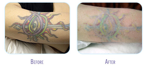 Laser Tattoo Removal Procedure at BodyLase after 5 treatments
