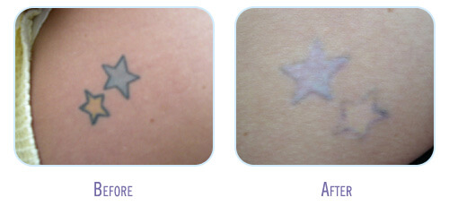 Laser Tattoo Removal Procedure at BodyLase After 6 Treatments