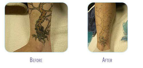 Easiest Tattoos To Remove? Cary NC Tattoo Removal - BodyLase Med Spa ...