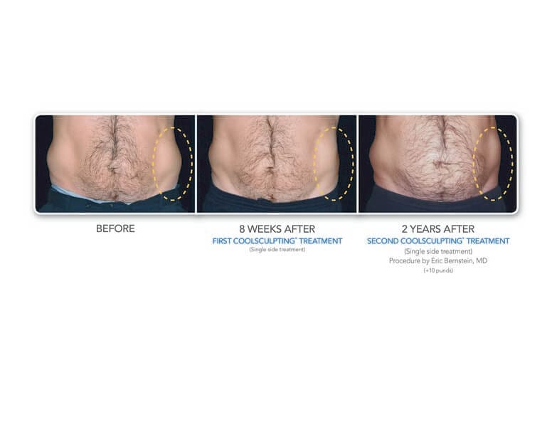 coolsculpting before and after gallery bodylase 174 med spa coolsculpting before and after gallery bodylase 174 med spa
