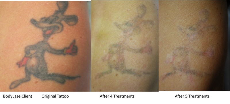 Tattoo Removal before and after1 BodyLase® Med Spa