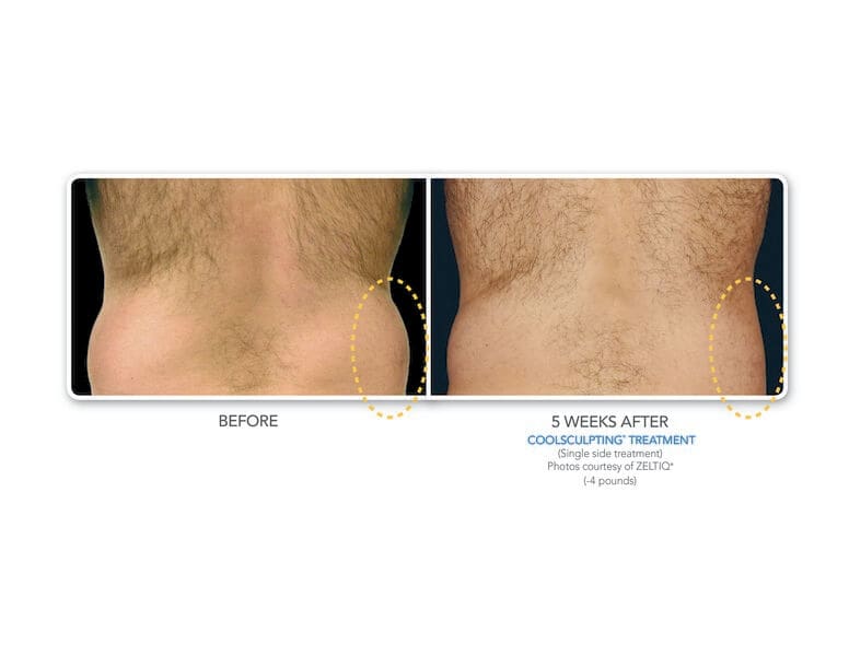 coolsculpting before and after gallery bodylase 174 med spa coolsculpting before and after gallery bodylase 174 med spa