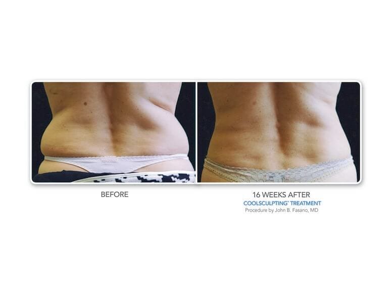 coolsculpting before and after gallery bodylase 174 med spa coolsculpting before and after gallery bodylase 174 med spa