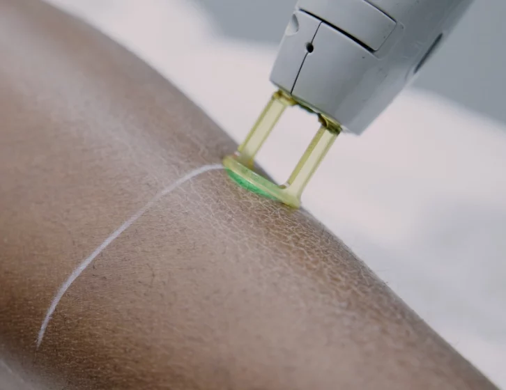 Laser Hair Removal for Dark Skin