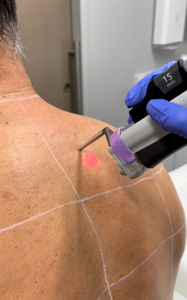 Laser Hair Removal