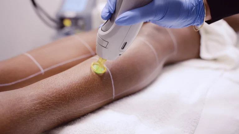 Laser Hair Removal for Dark Skin: Your Guide to Safe, Smooth, and Bump-Free Skin