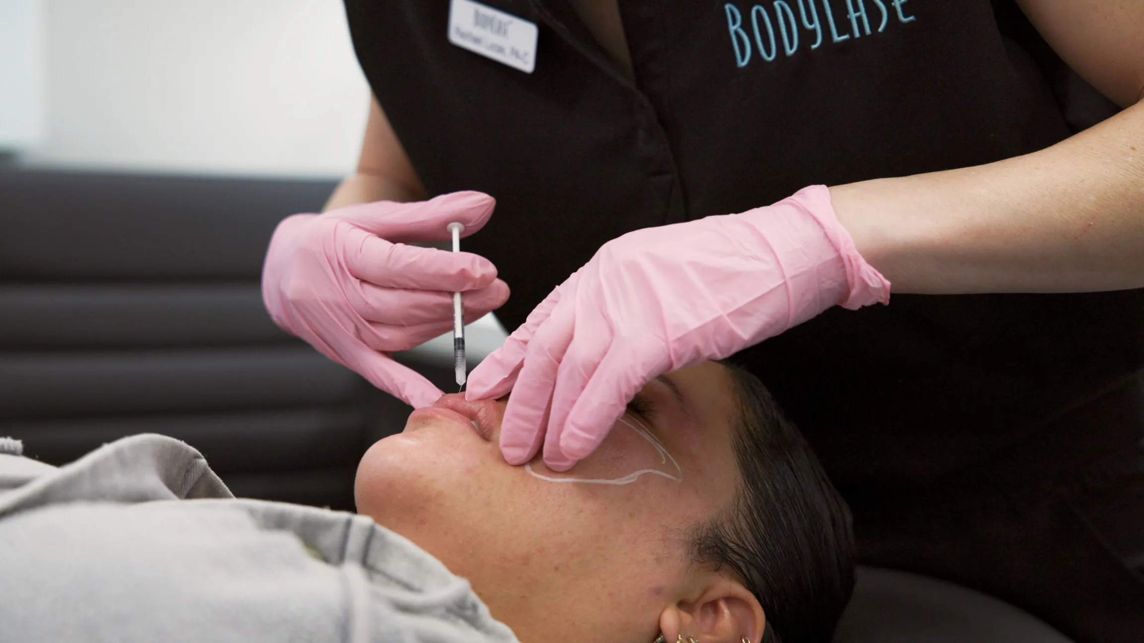 BodyLase® Med Spa - lip filler 1 1