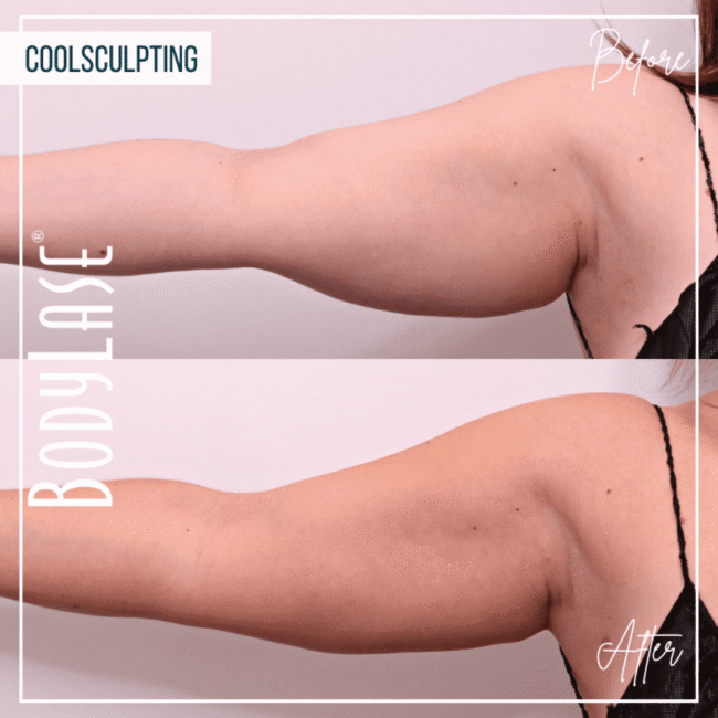 CoolSculpting Elite Before and After: A Complete Guide to the Fat Freezing Procedure