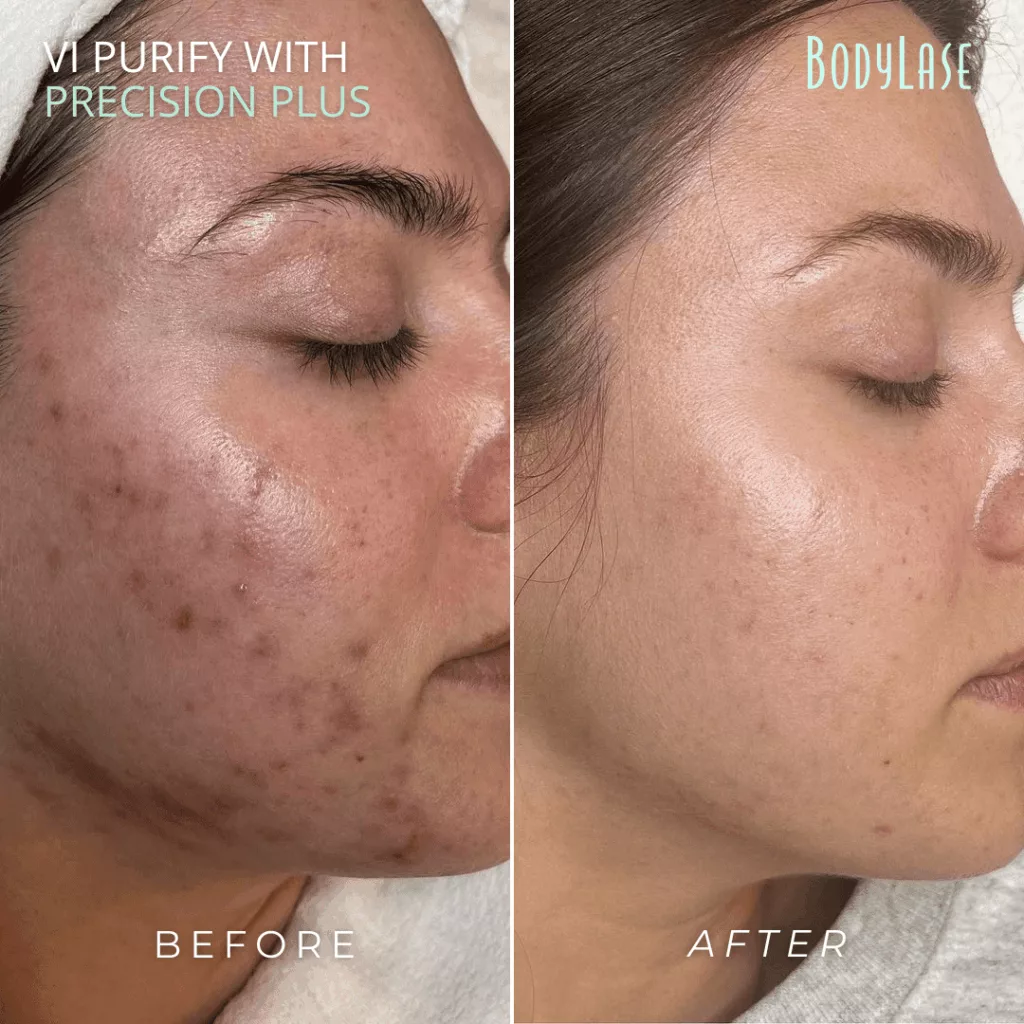BodyLase® Med Spa - BA VI Peel Precision Plus from Brand Box