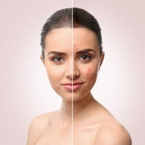 How To Get Rid Of Acne Scars