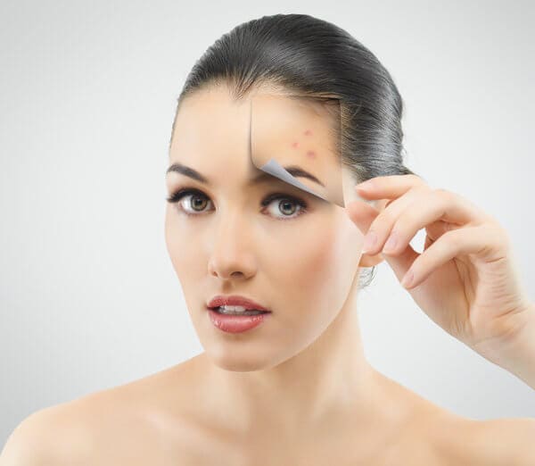 How Laser Skin Treatments can Improve Acne Scars