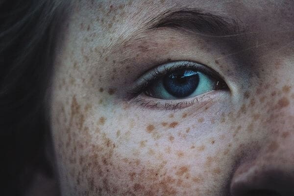 Microneedling vs. IPL for Dark Spots