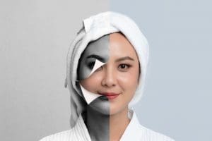 BodyLase® Med Spa - BodyLase melasma treatments 300x200 1