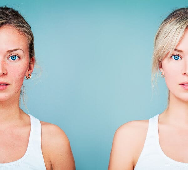 National Rosacea Month: Skin Treatments that Help Improve Rosacea