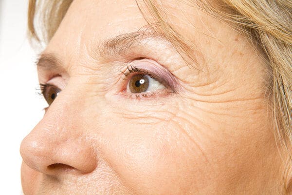 Wrinkle Treatments for Eyes