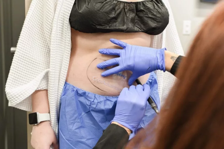 What is Coolsculpting? An In-Depth Guide for 2026