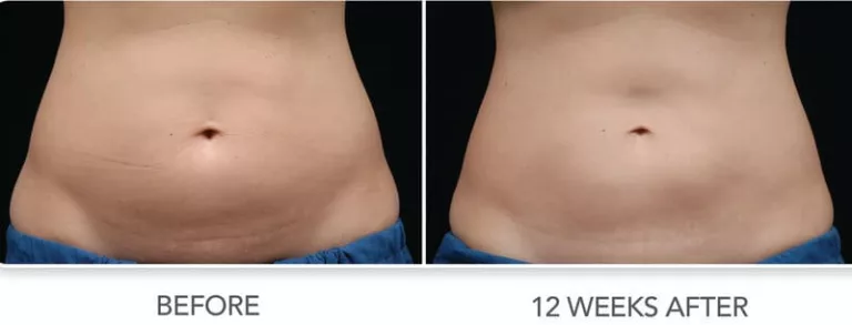 Wedding Series: Lose the Belly Bulge