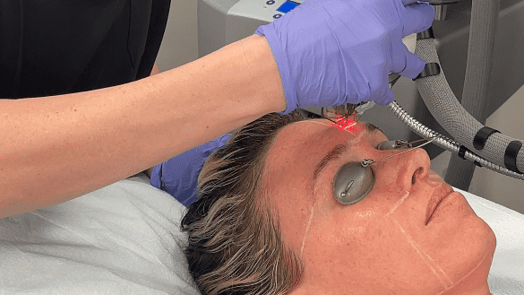 BodyLase® Med Spa - Fraxel Laser Skin Resurfacing2 BodyLase edited