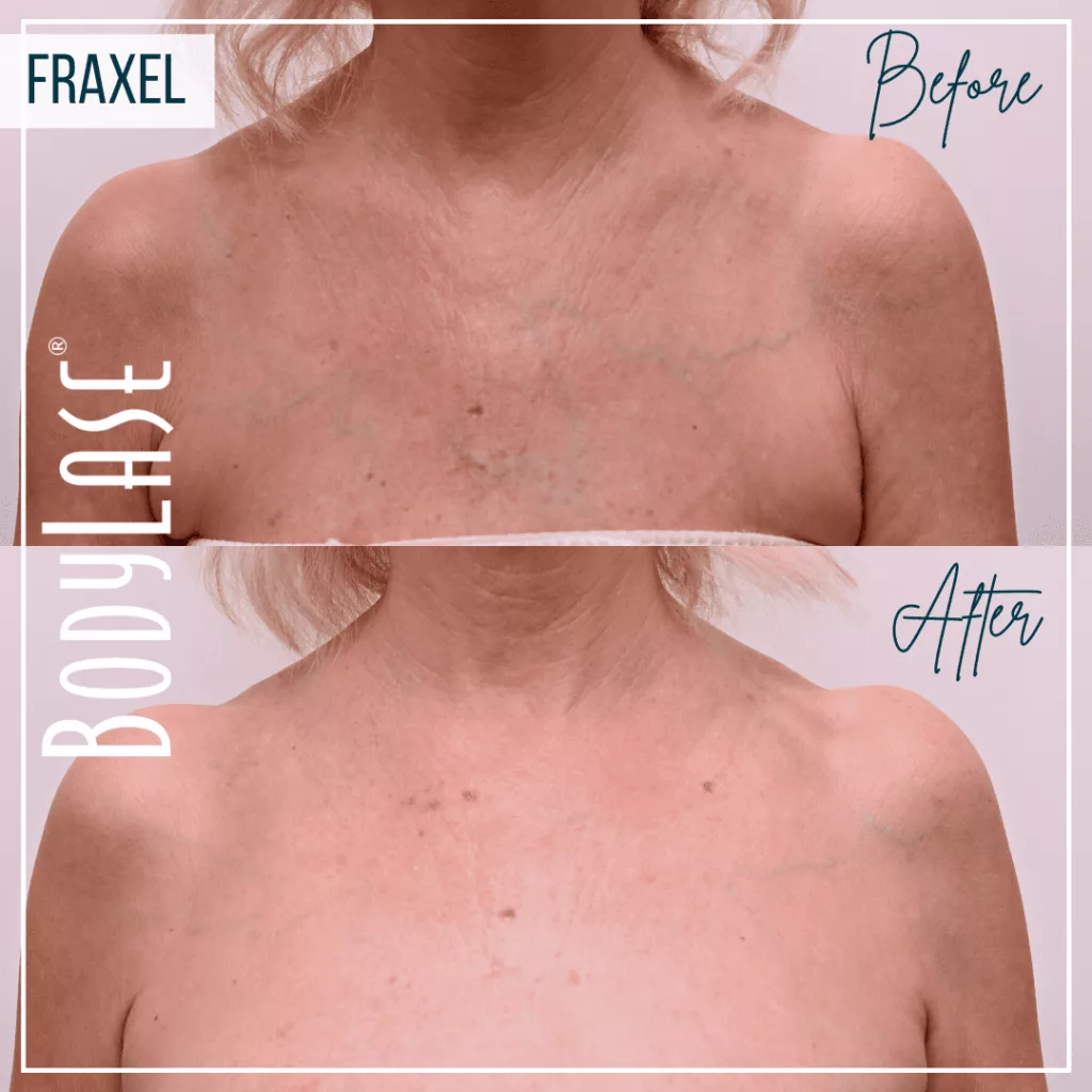 BodyLase® Med Spa - Fraxel1