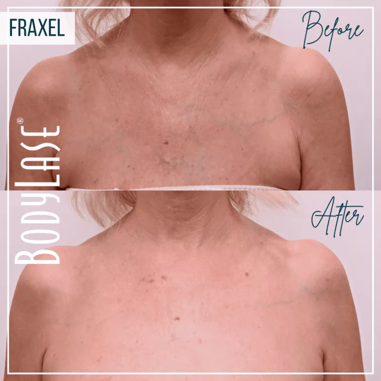 All About Laser Skin Resurfacing: How Does Fraxel Work?