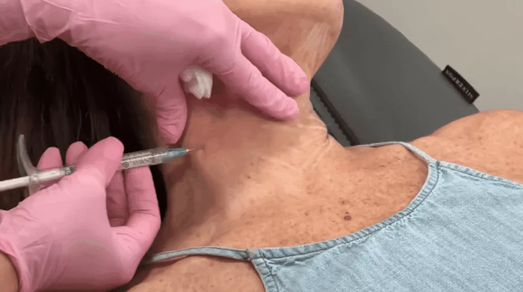 BodyLase® Med Spa - Hyperdilute Radiesse horizontal BodyLase