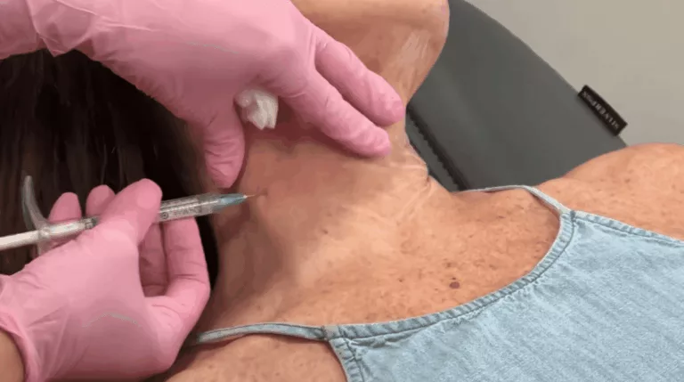 What is Hyperdilute Radiesse? 