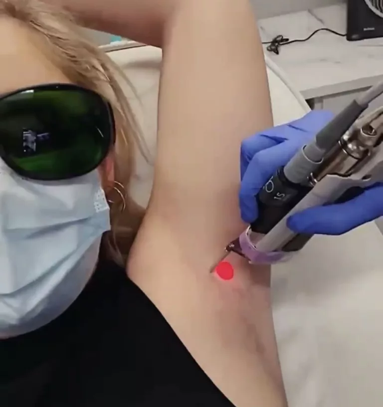 What is the Best Laser Hair Removal Machine?