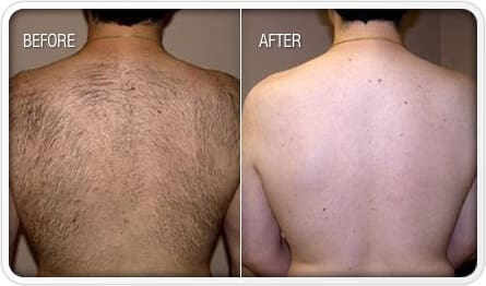 Hair Removal Cary NC