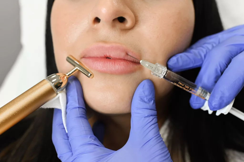 BodyLase® Med Spa - LipFiller 37