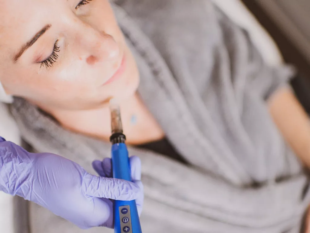 BodyLase® Med Spa - Microneedling3 39 edited