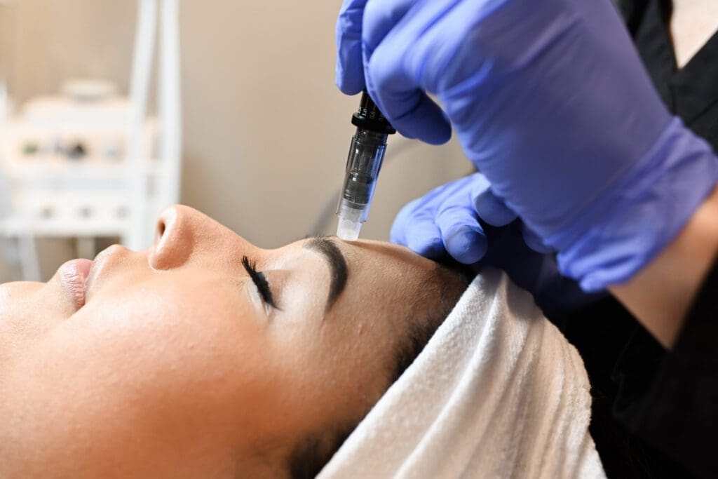 BodyLase® Med Spa - Microneedling3 scaled 1 1024x683 1