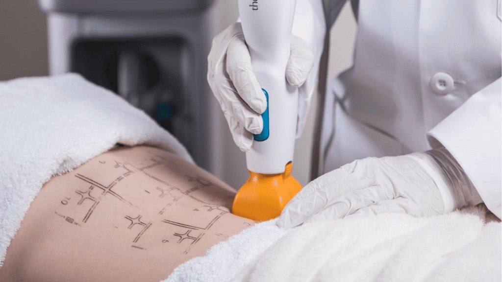 BodyLase® Med Spa - Regenerative Aesthetic Treatments Thermage Morpheus8 VirtueRF Hyperdilute Radiesse