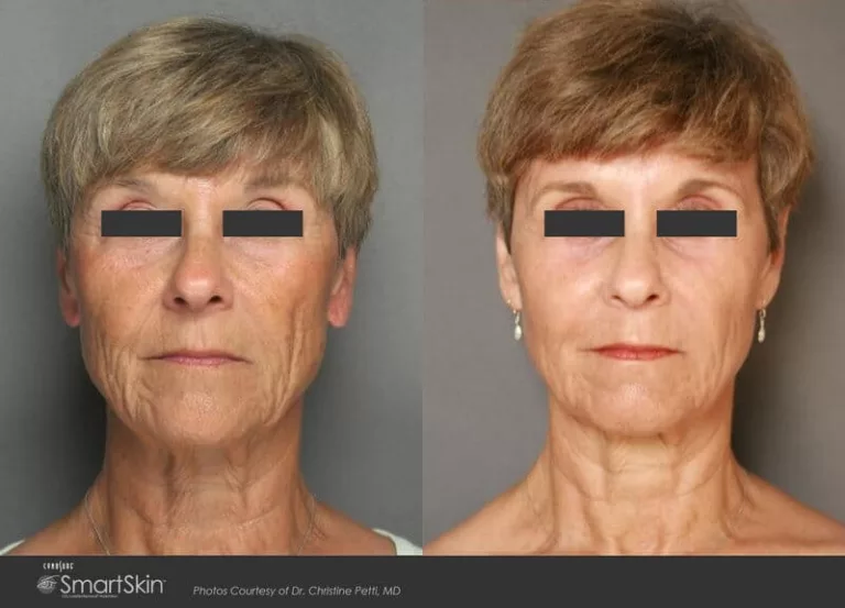 Fractional CO2 before and after