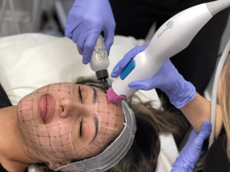 What You Need To Know About Thermage Treatment
