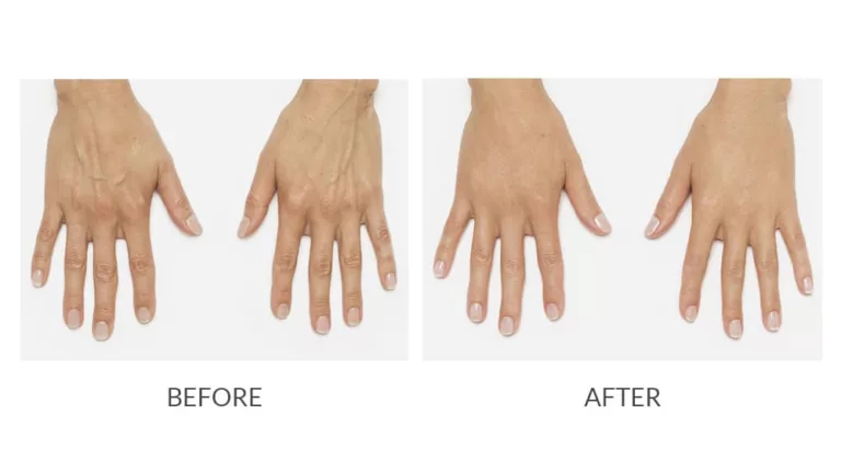 Youthful Hands: Avast Ye, Collagen Damage!