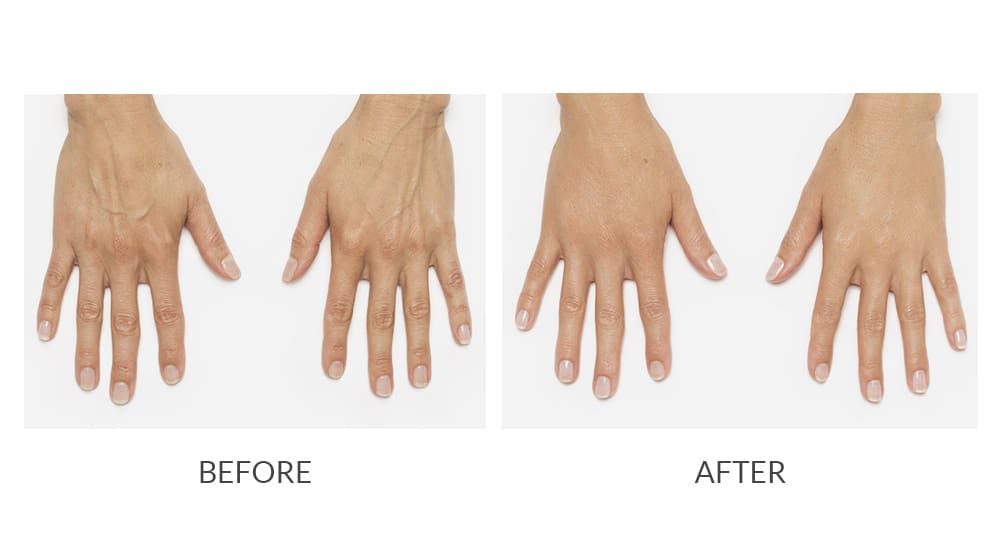 BodyLase® Med Spa - radiesse 1